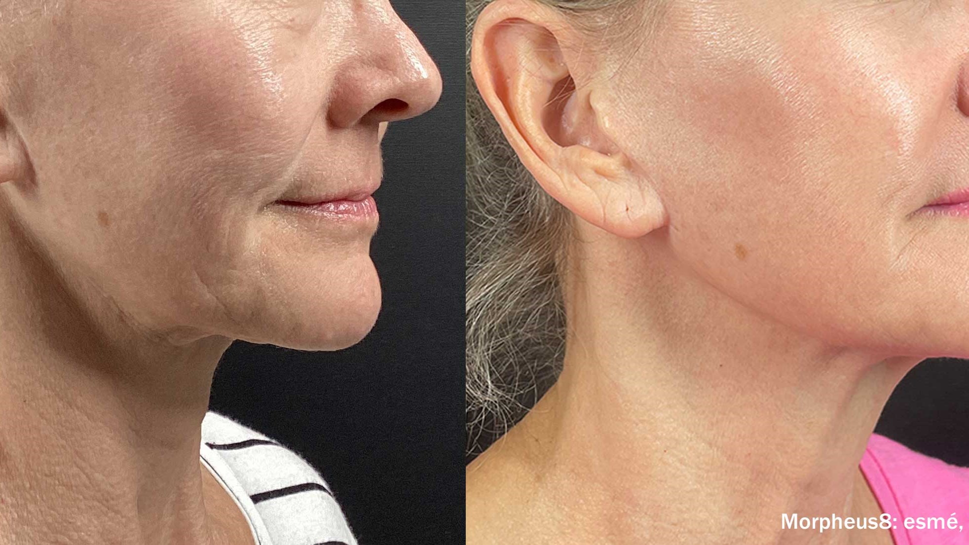 before/after